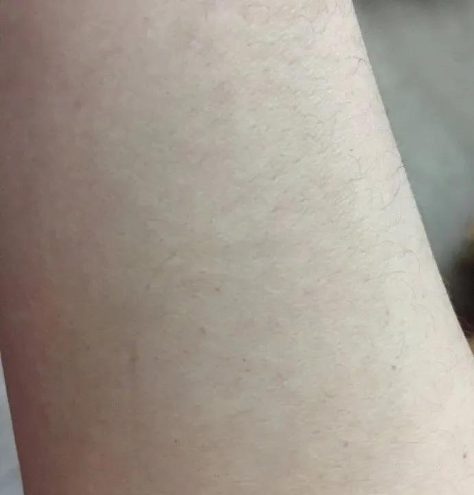 「患者咨询」回答一些近期患者提问的白斑问题