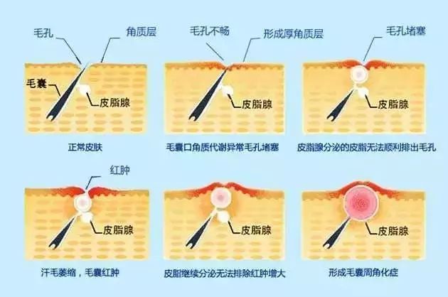 角质层薄脸上有红血丝怎么调理,角质层薄有红血丝脸发红怎么修复