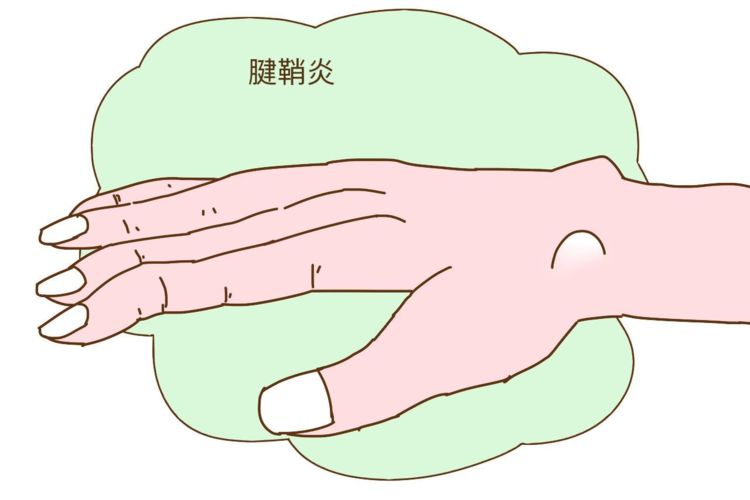 大拇指不敢动还很疼？可能是腱鞘炎，手脚别太“勤快”该歇就歇会