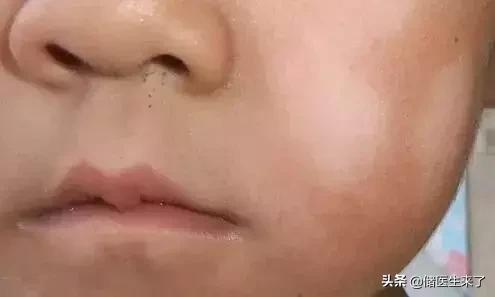 24种皮肤病用药指南,儿童皮肤病的症状和治疗方法