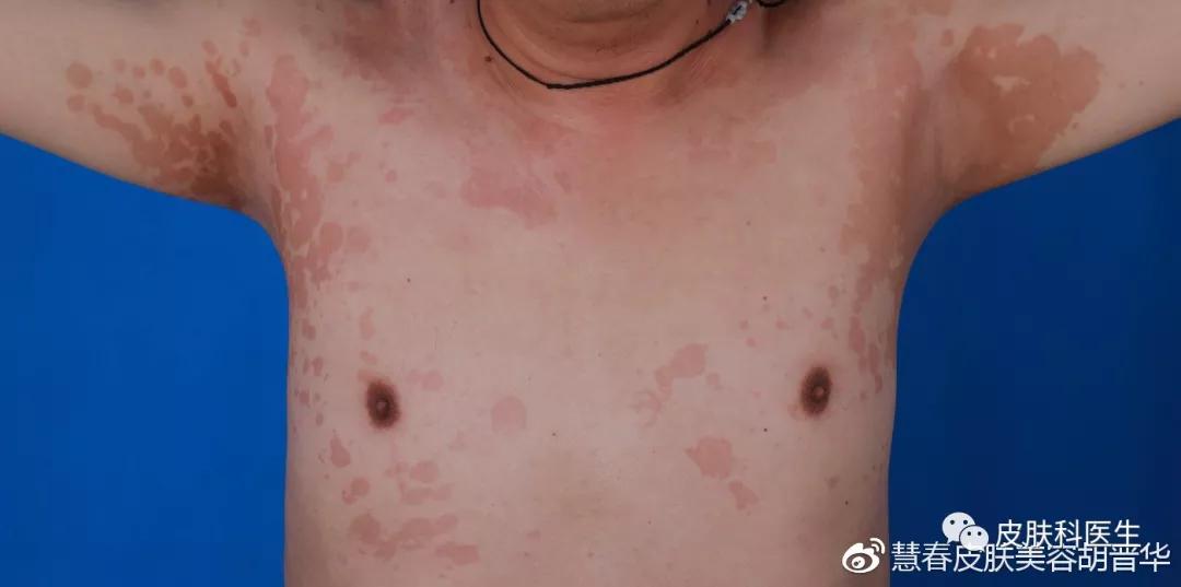 是不是皮肤癣，皮肤真菌镜检来告诉你！