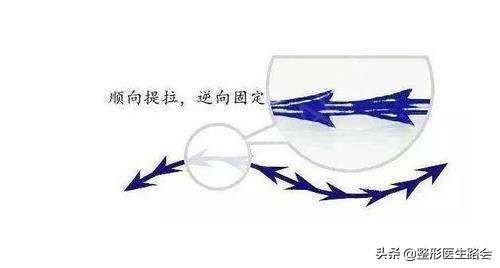 为什么不建议做线雕手术,为什么不推荐做线雕鼻