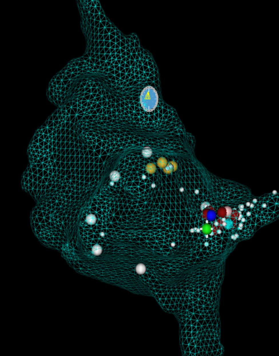 得了预激综合征严重吗,为什么会得预激综合征
