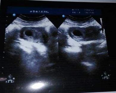 产检b超单上有个x,产检b超单医生都收回去吗