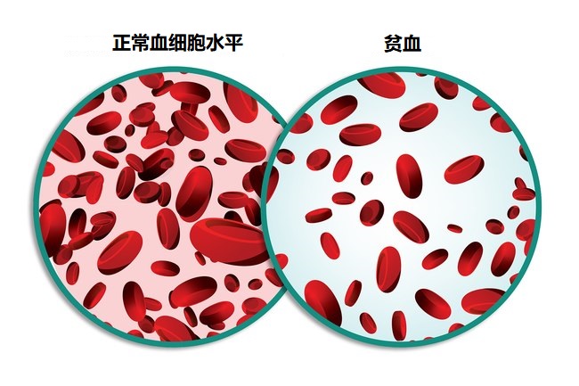 有没有不吃药补铁快的方法,补铁吸收不了怎么办
