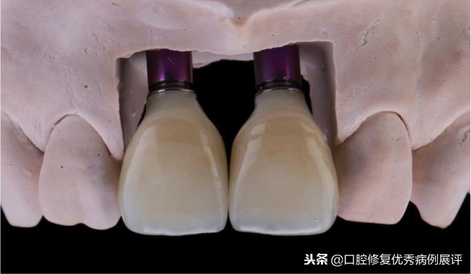 展评优秀病例赏析|Asc全瓷角度基台一体冠进行种植前牙美学修复