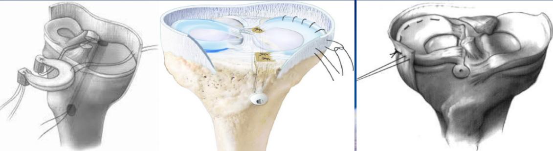 半月板损伤的症状及治疗方法,半月板损伤自测