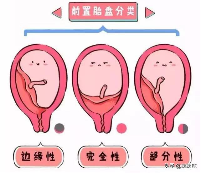 前壁胎盘和前置胎盘有什么区别,前壁胎盘和前置胎盘的区别有哪些