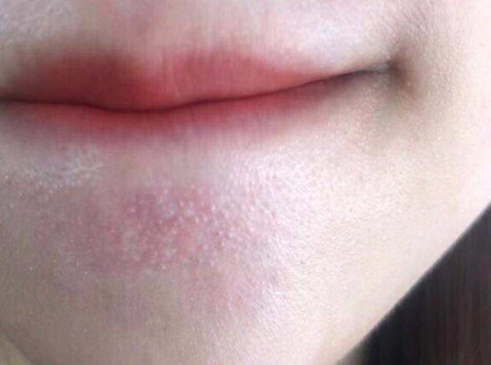 痘坑痘印消炎修复的最佳方法,是不是痘痘消炎了就有痘坑