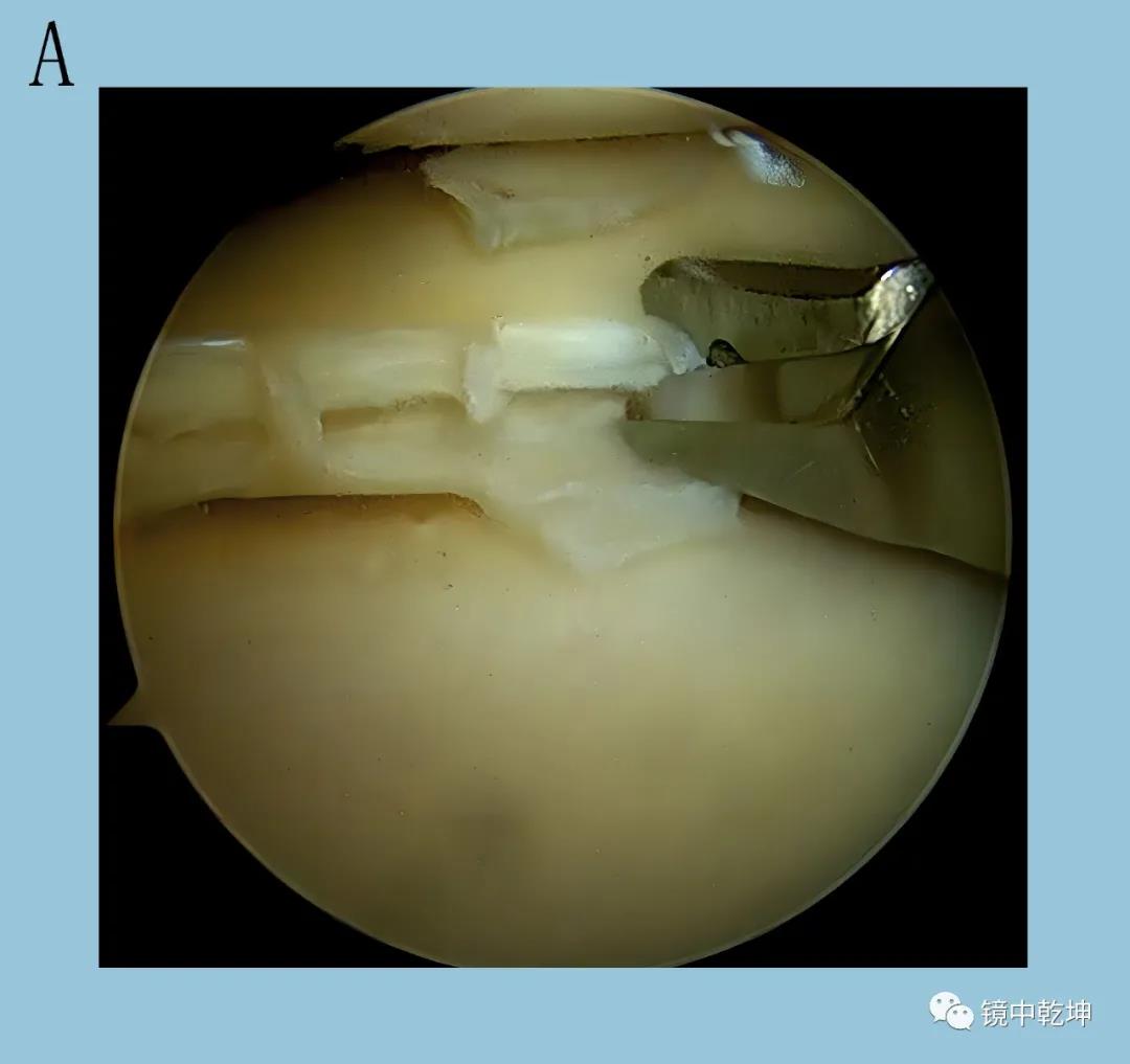 南大二附院系列科普：关节镜手术治疗膝关节半月板损伤