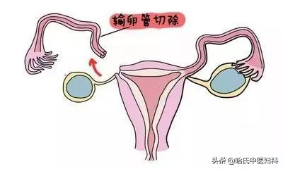 切输卵管，是妇产科最简单的手术？——输卵管不愿意了