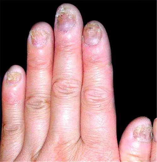 灰指甲应该怎么治医生教你三招,灰指甲为什么会得的