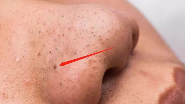 细致皮肤告别草莓鼻,低成本三步告别草莓鼻