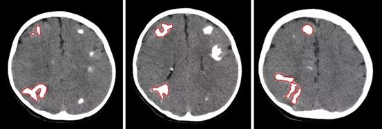 几百个“玉米粒”长满了7岁男孩的脑子，妈妈上演现实版药神