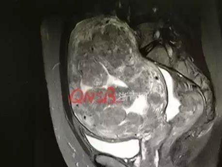 女性体内取出71个肌瘤,手术中挖出的子宫肌瘤