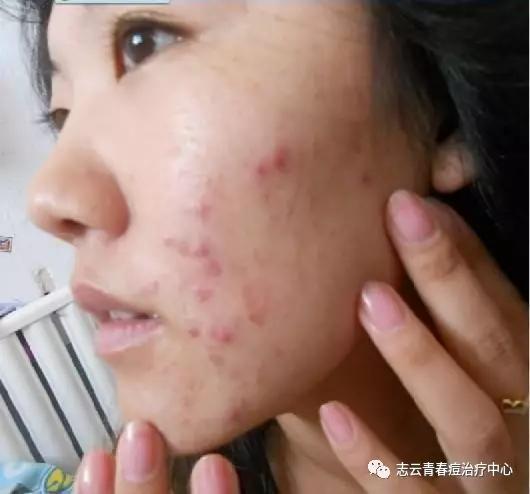 脸上起痘了怎么祛痘最有效,脸上长痘怎么办教你一招轻松祛痘