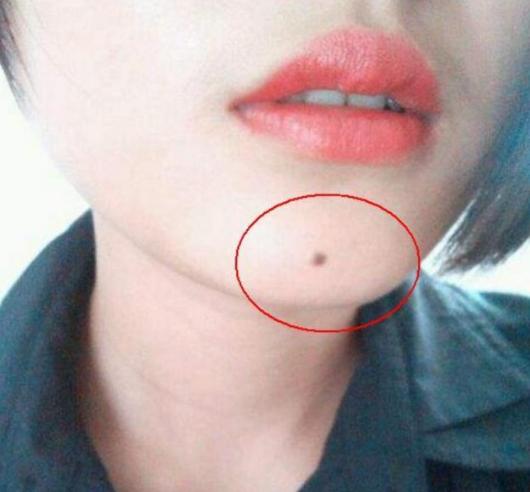 脸上痣掉了留下黑疤怎么处理,脸上痣怎么去除不留疤还安全