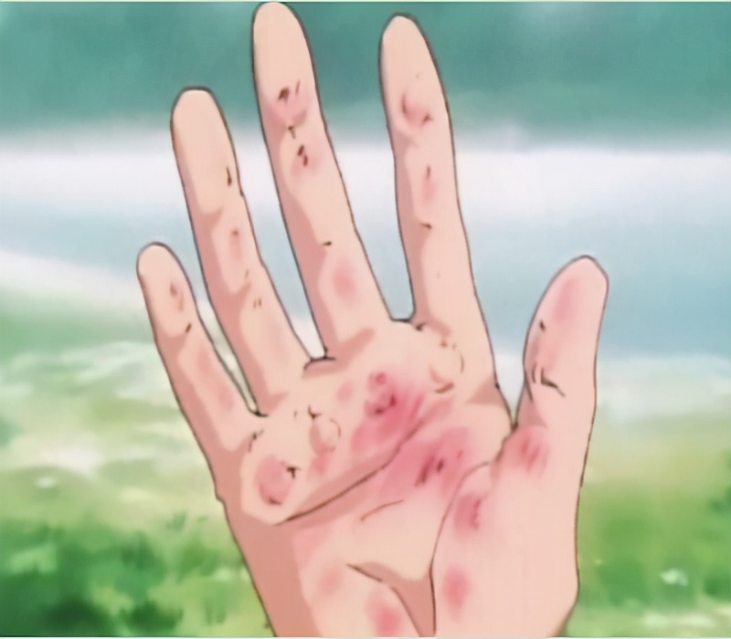 手心汗流不止！随着年龄增长，会好吗？医生：别大意