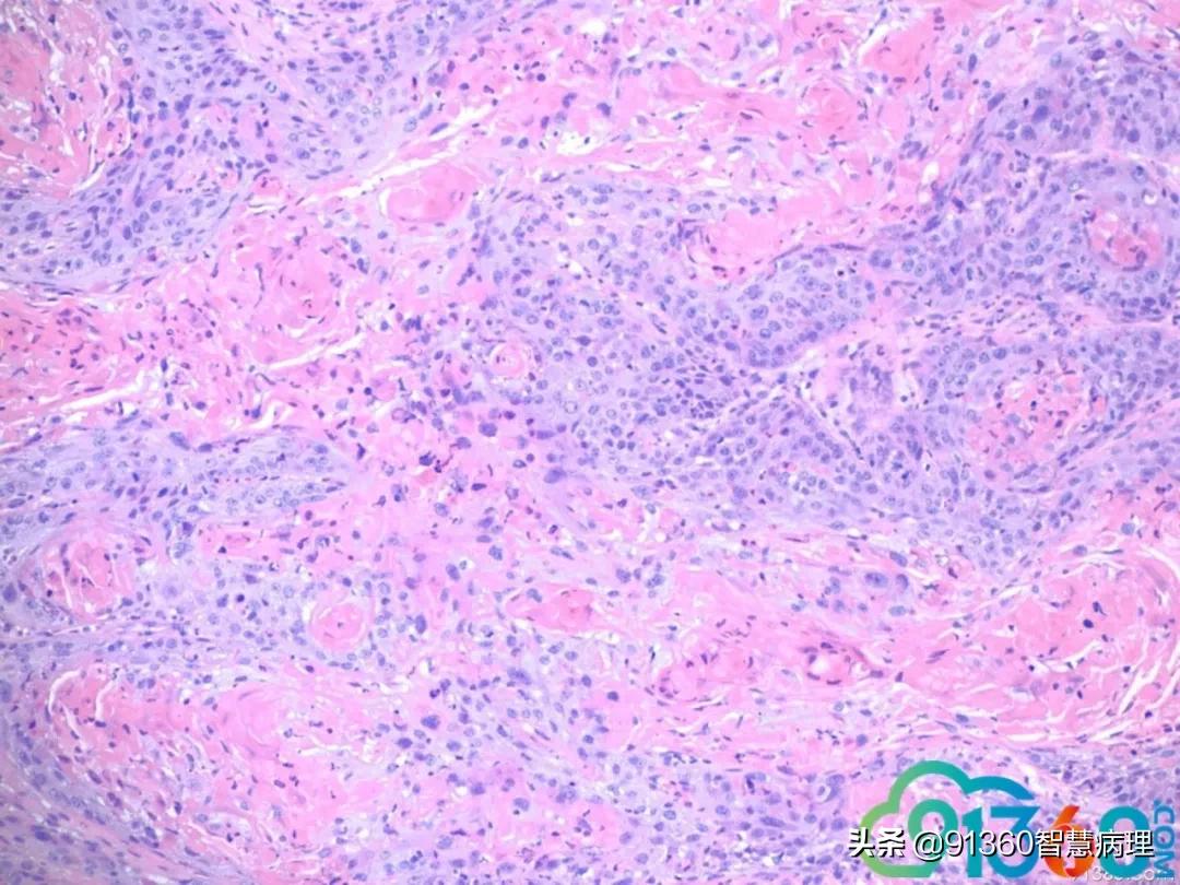 病理宫颈活检lsil是什么意思,宫颈病理检查与tct检查的区别