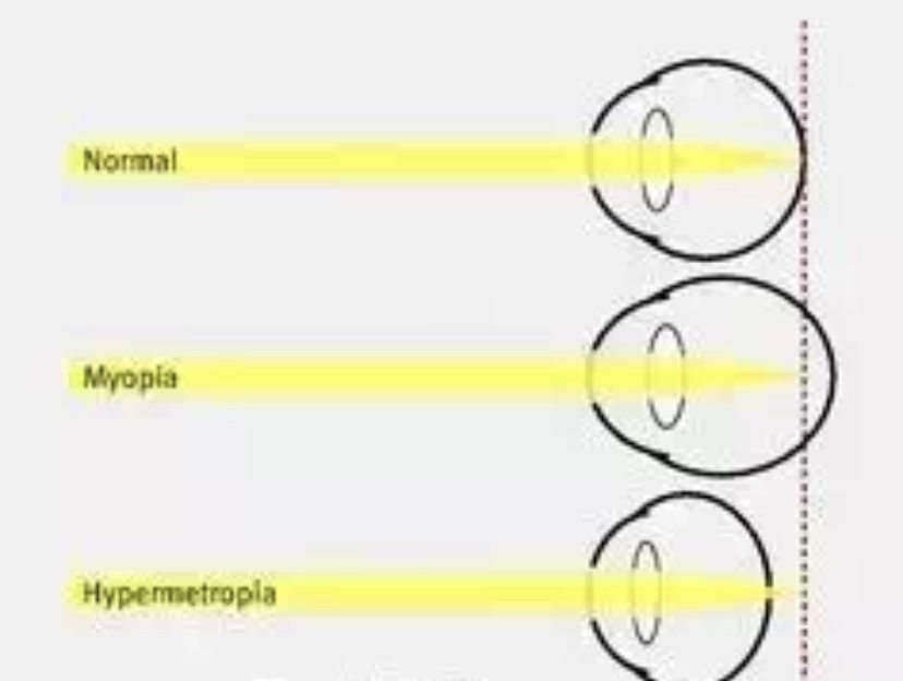 8岁50度远视储备怎么预防近视,远视储备4岁就没有了怎么办