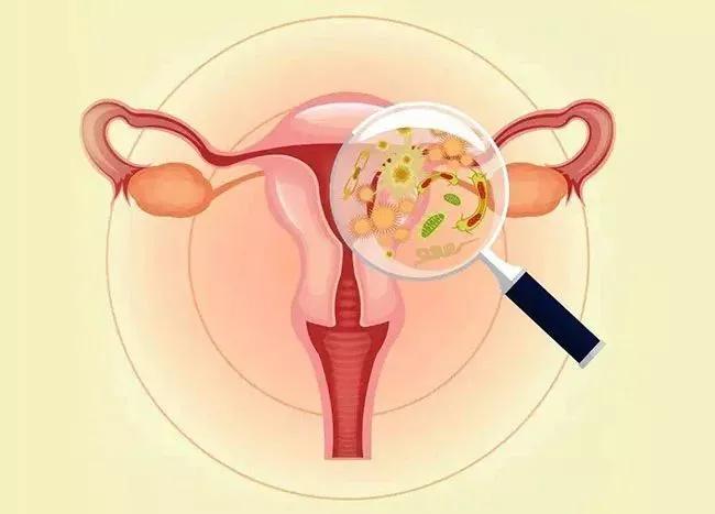 孕期阴道炎对宝宝有影响吗？