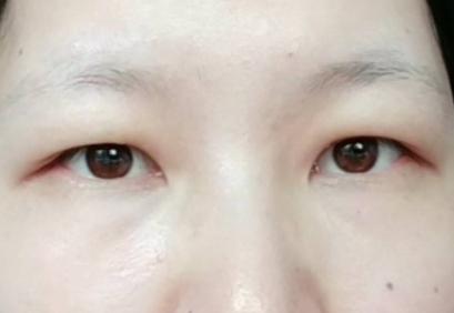 割双眼皮要怎样才知道合适自己,割过双眼皮和没割过双眼皮的区别