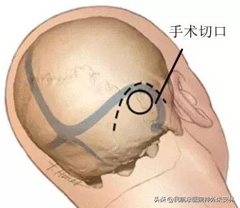 血管压迫三叉神经痛会痛一辈子吗,原发与继发三叉神经痛如何治疗