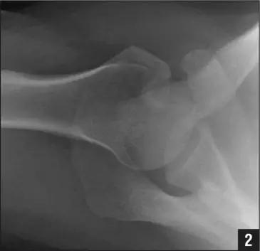 几种严重骨折医学名称,常见的骨折有哪些名称