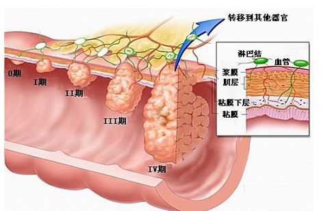 三期结直肠癌dmmr化疗方案,直肠癌化疗方案卡培他滨副作用