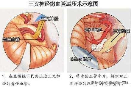 哈尔滨脑神经外科哪个医院好些,齐齐哈尔三叉神经微创手术