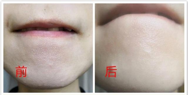 顽固多年黑头闭口毛孔粗大怎么办,南京皮肤病研究所顽固闭口粉刺