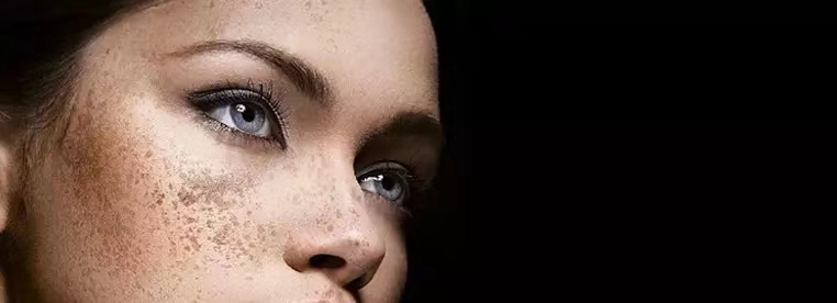 褐斑的原因及治疗方法,褐斑的原因和治疗方法