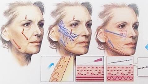 面部抗衰老有哪些项目,面部抗衰老有哪些整形项目