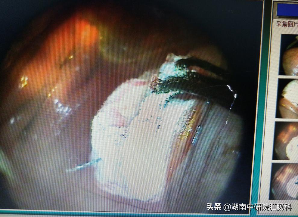 低位直肠癌早期能保肛吗,低位直肠癌晚期治愈吗