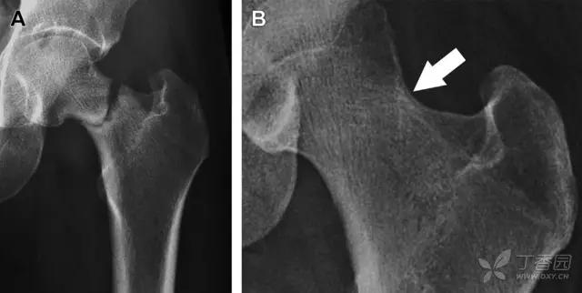 放射科夜班病例大全,放射科容易漏诊的骨折