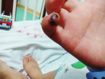 宝宝手指夹烂了怎么处理,宝宝手夹伤用什么药