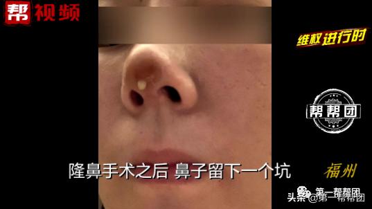做了隆鼻几年了突然流脓,隆鼻一个月鼻孔里面伤口有脓点
