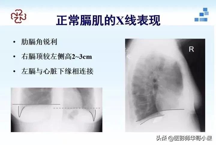 「精品课件」胸部膈肌的解剖及常见病变影像的表现