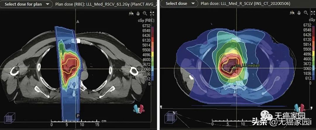 质子治疗手术适合大型肿瘤,肿瘤不能根治吗
