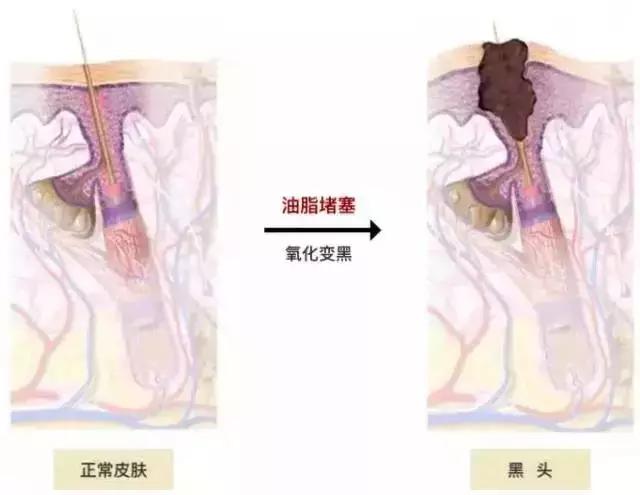 根治黑头的最佳方法,怎么才能彻底治好黑头