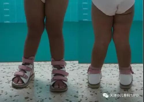 8岁孩子足外翻有必要治吗,骨科医生谈幼儿脚内扣