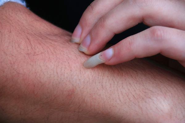 感染艾滋病皮肤会有变化吗,感染艾滋病皮肤上有什么变化