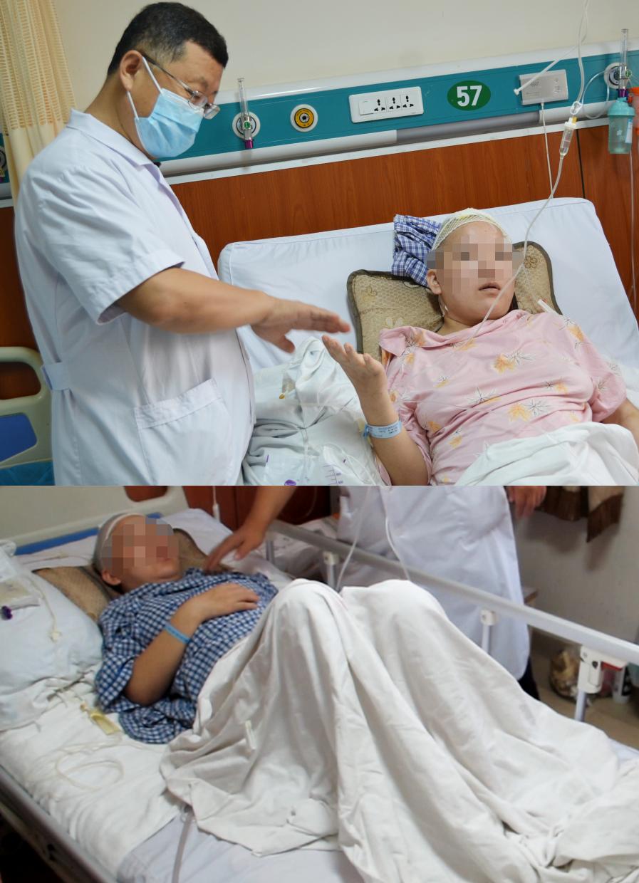 脑室有粘连脑积水有什么办法,脑动脉畸形手术后出现急性脑积水