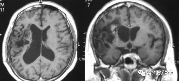 什么引起成人脑室扩大,哪些病可以导致左侧脑室增宽