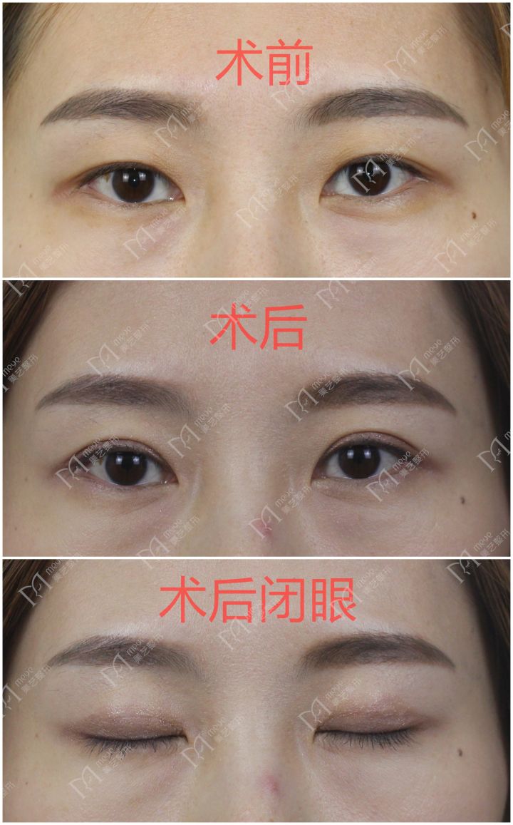 双眼皮线条凹陷疤痕怎么修复,双眼皮手术后如何避免疤痕和增生