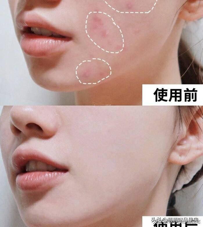 祛痘强效药,超好用的祛痘方法