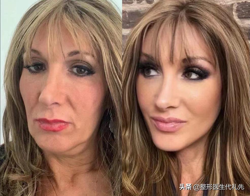 人中长显老怎么化妆改善,人中长显老怎么改善