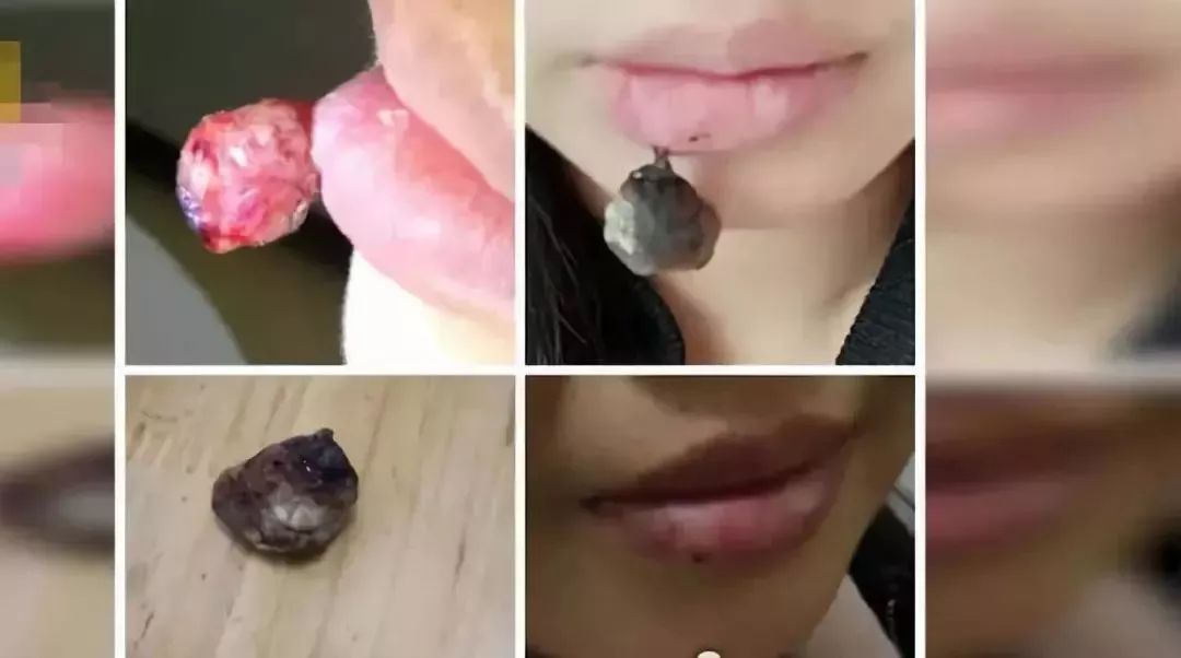 孕期不小心把嘴巴咬破了怎么办,怀孕初期嘴不小心咬破了