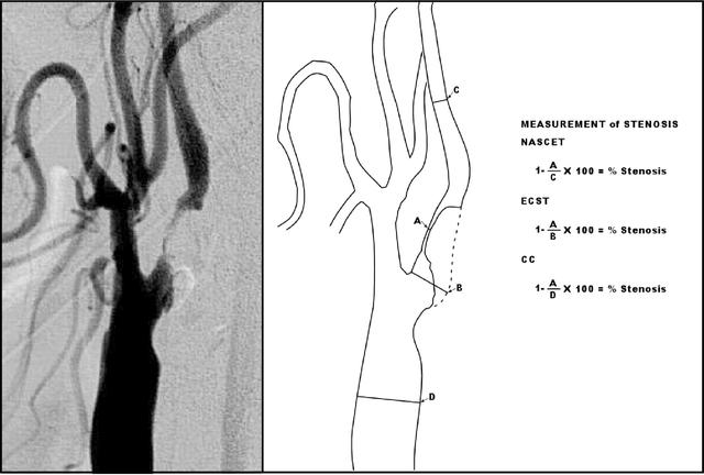 成年人脑梗继发癫痫最佳治疗方法,脑梗死癫痫部分发作
