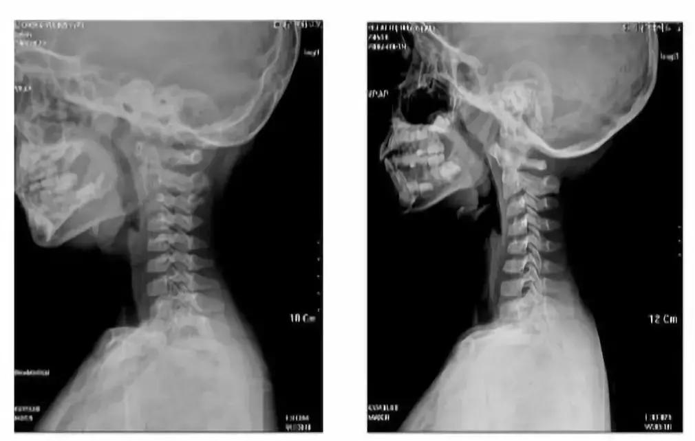 “减负”太遥远，现在我只想保住孩子的颈椎